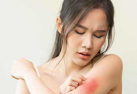 Sun and heat can trigger eczema